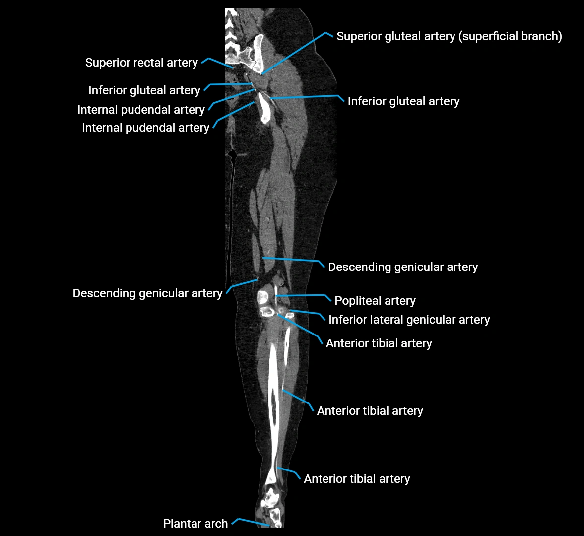 CTA lower limb coronal cross sectional anatomy labelled image _59 (2).webp
